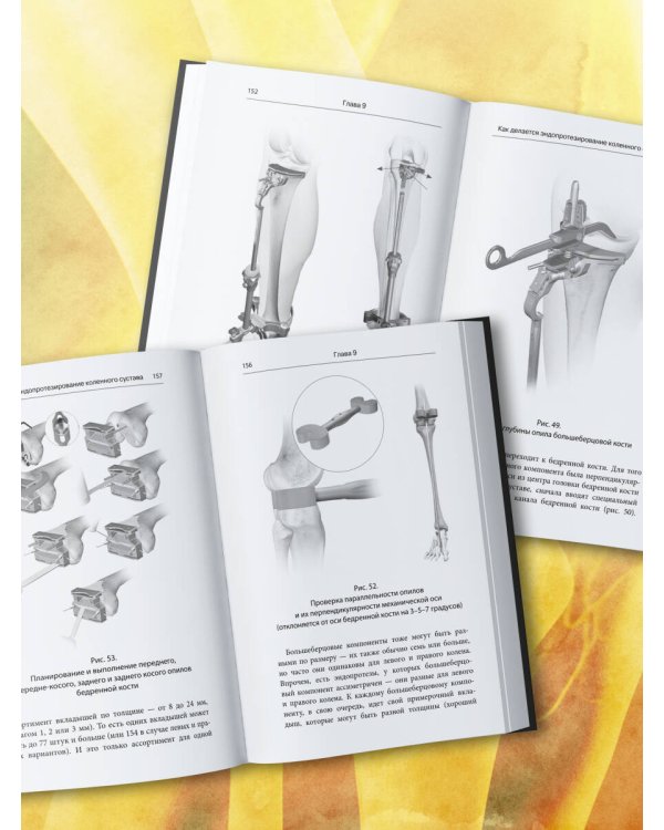 Эндопротезирование коленного сустава: ответы практикующего врача на все вопросы пациентов