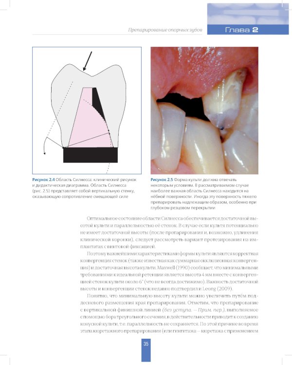 Вертикальное препарирование зубов под несъемные ортопедические конструкции