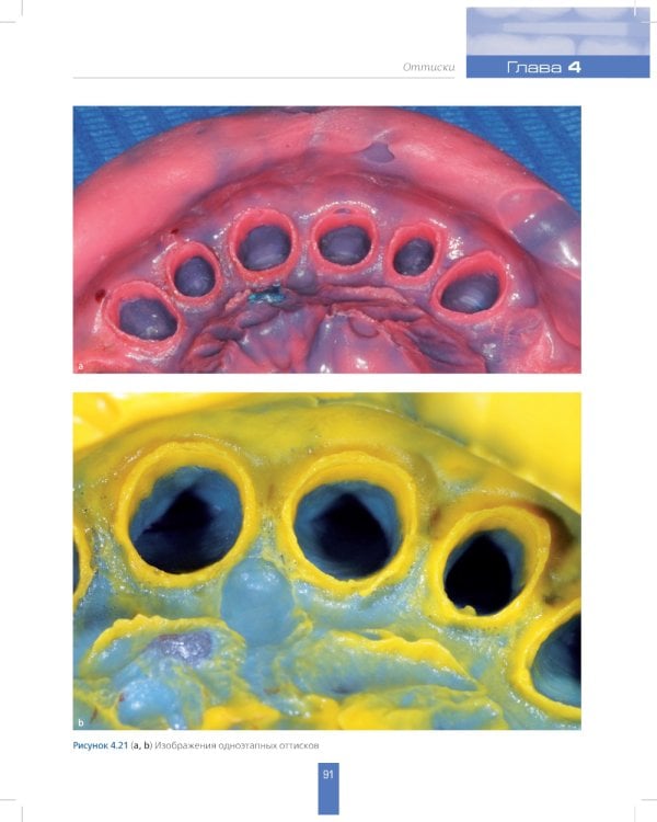 Вертикальное препарирование зубов под несъемные ортопедические конструкции