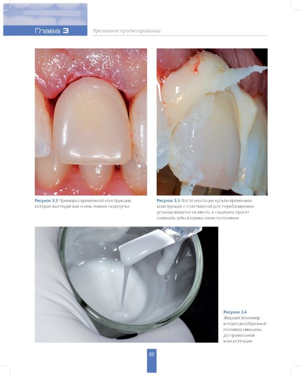 Вертикальное препарирование зубов под несъемные ортопедические конструкции