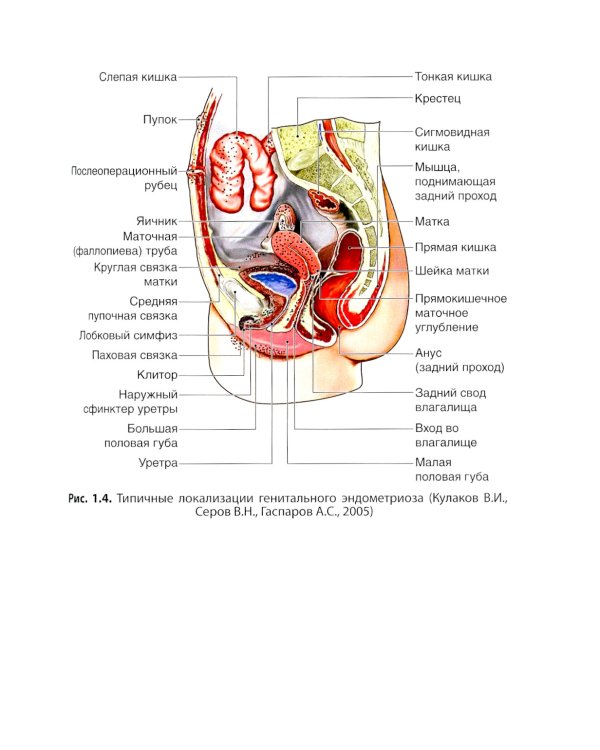 Генитальный эндометриоз. Новый взгляд на старые проблемы