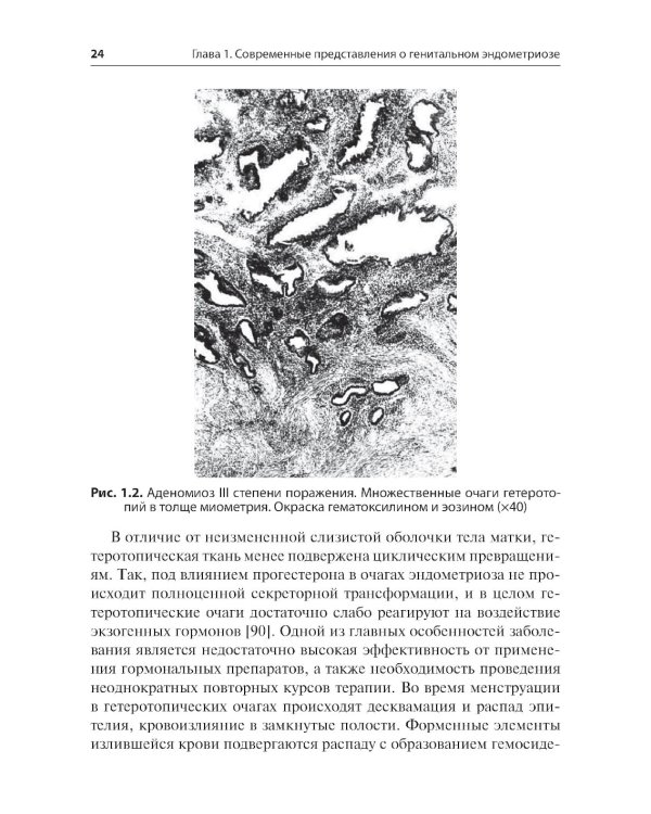 Генитальный эндометриоз. Новый взгляд на старые проблемы