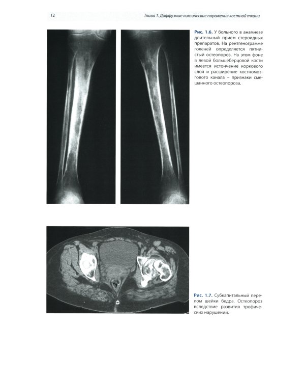 Лучевая диагностика патологии костной ткани. 2-е изд