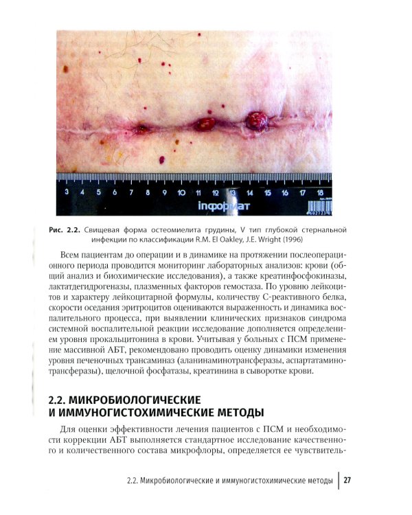 Послеоперационный стерномедиастинит. Комплексный подход к лечению