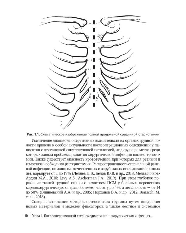 Послеоперационный стерномедиастинит. Комплексный подход к лечению
