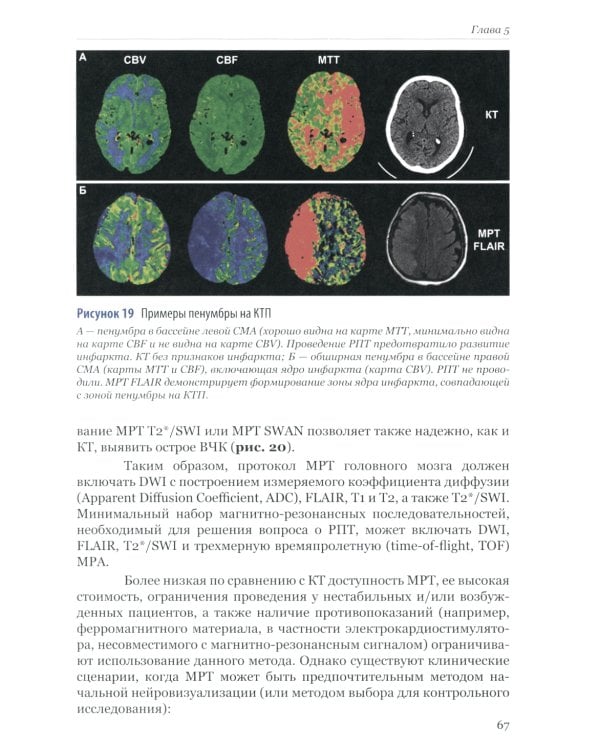 Ишемический инсульт: диагностика, лечение, реабилитация и профилактика. Руководство для врачей