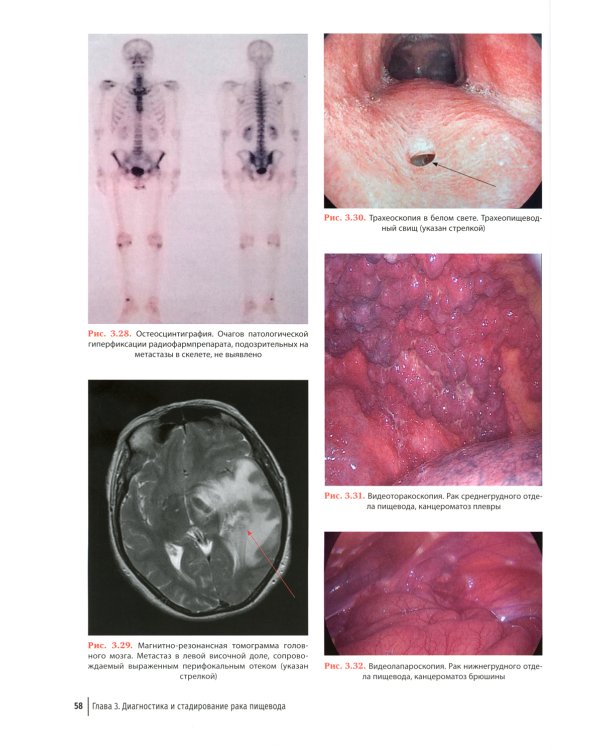 Рак пищевода: диагностика и комплексное лечение