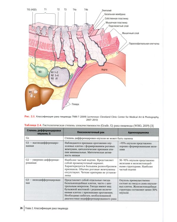 Рак пищевода: диагностика и комплексное лечение