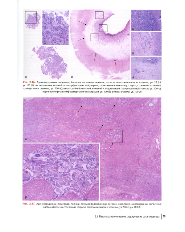 Рак пищевода: диагностика и комплексное лечение