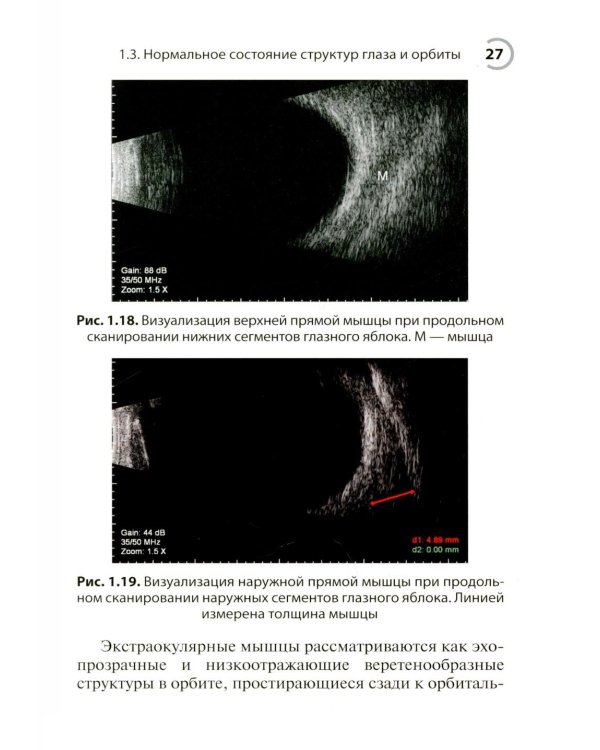 УЗИ в офтальмологии