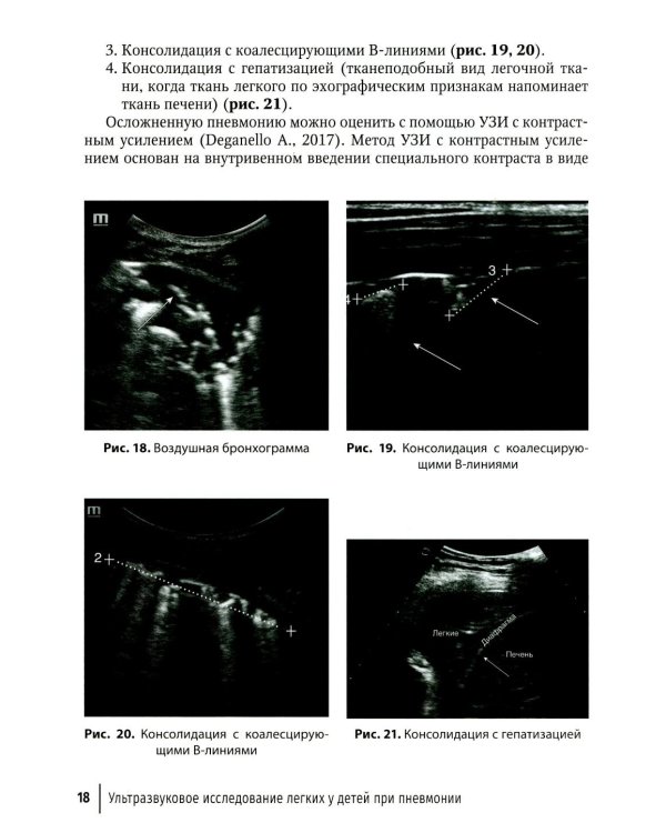 Ультразвуковое исследование легких у детей при пневмонии