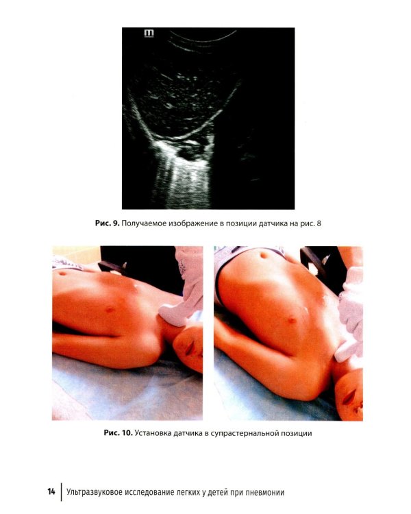 Ультразвуковое исследование легких у детей при пневмонии