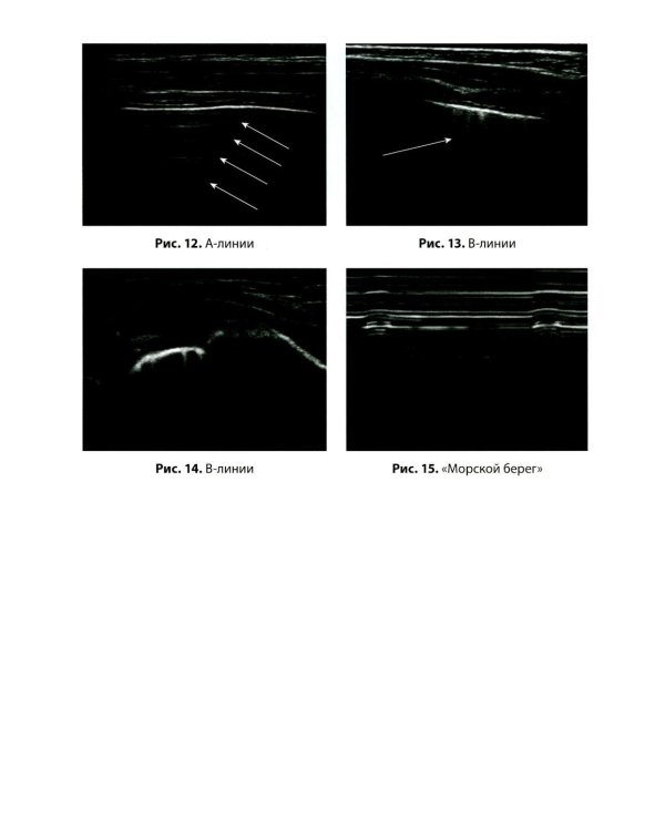 Ультразвуковое исследование легких у детей при пневмонии