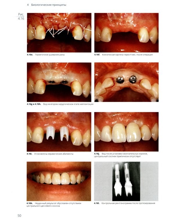 Имплантация в эстетически значимой зоне. Поэтапный алгоритм планирования лечения