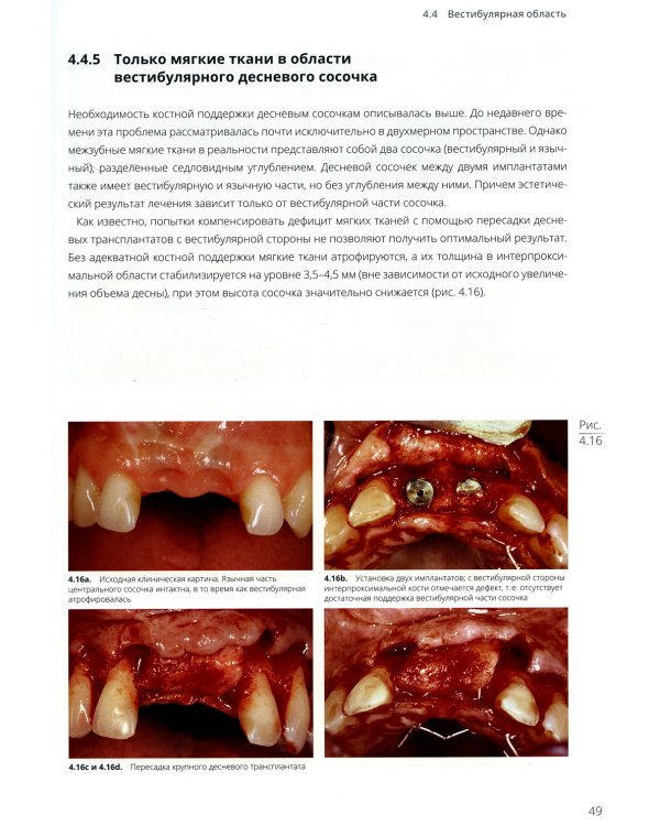 Имплантация в эстетически значимой зоне. Поэтапный алгоритм планирования лечения