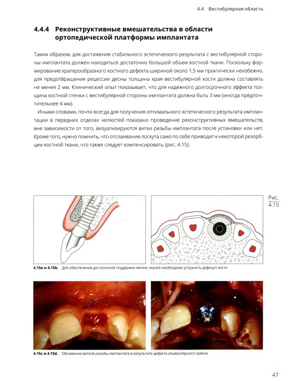 Имплантация в эстетически значимой зоне. Поэтапный алгоритм планирования лечения