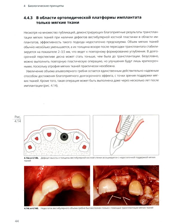 Имплантация в эстетически значимой зоне. Поэтапный алгоритм планирования лечения