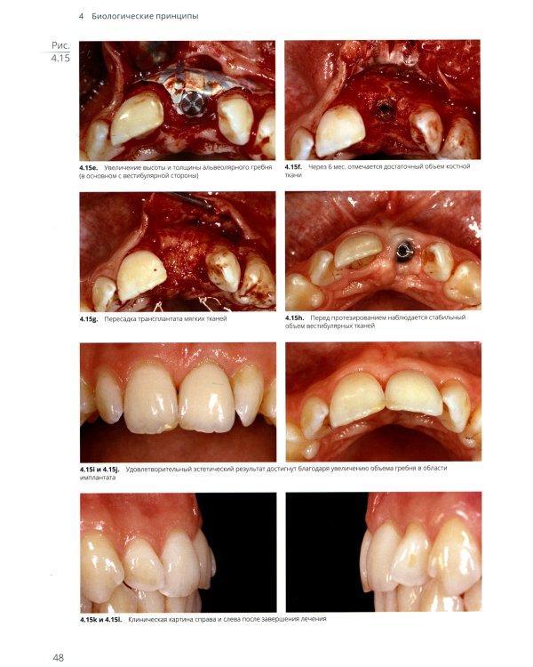 Имплантация в эстетически значимой зоне. Поэтапный алгоритм планирования лечения