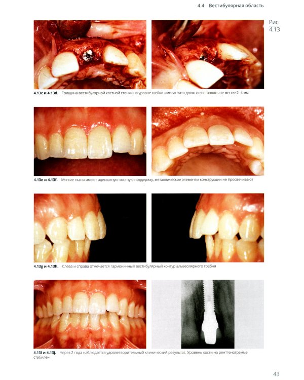 Имплантация в эстетически значимой зоне. Поэтапный алгоритм планирования лечения