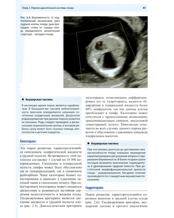 Ультразвуковая диагностика врожденных пороков развития плода