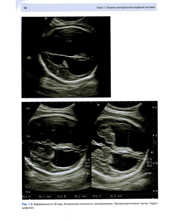 Ультразвуковая диагностика врожденных пороков развития плода