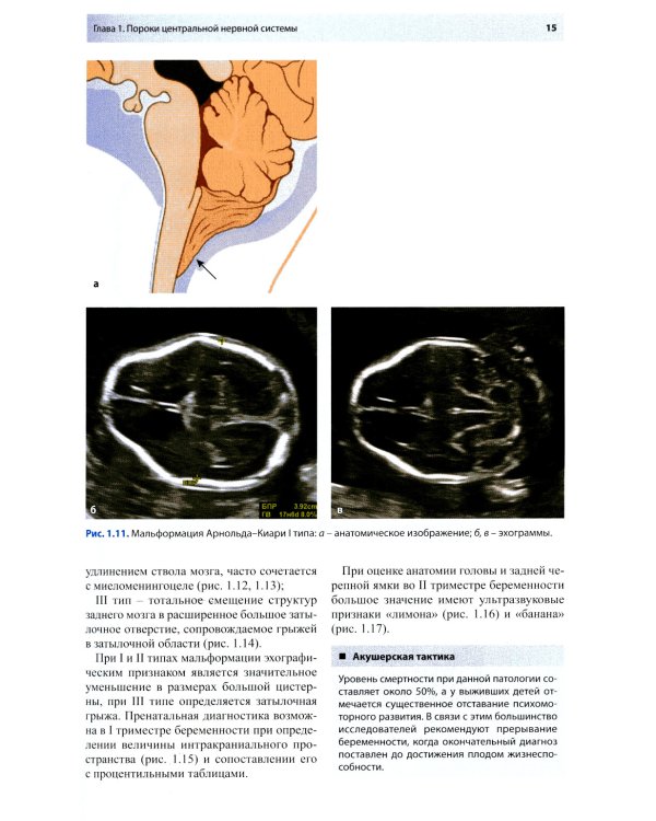 Ультразвуковая диагностика врожденных пороков развития плода