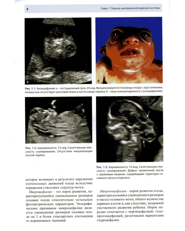 Ультразвуковая диагностика врожденных пороков развития плода