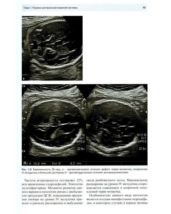 Ультразвуковая диагностика врожденных пороков развития плода