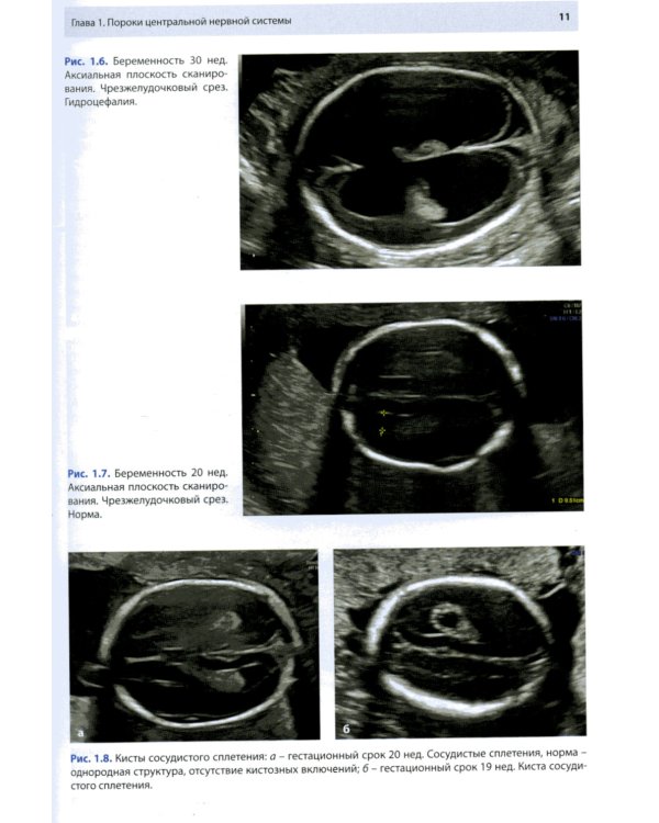 Ультразвуковая диагностика врожденных пороков развития плода
