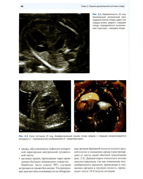 Ультразвуковая диагностика врожденных пороков развития плода