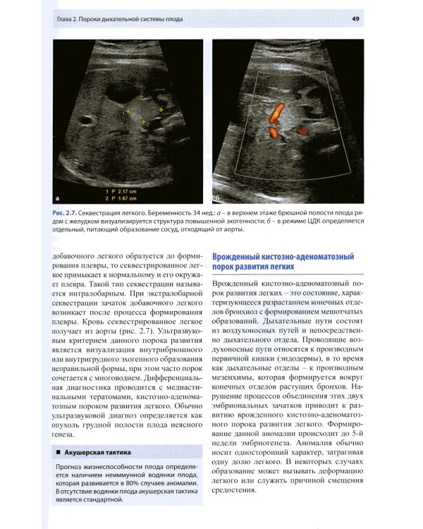 Ультразвуковая диагностика врожденных пороков развития плода