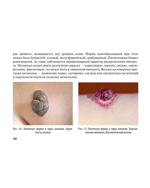 Рак кожи. Меланома: руководство для врачей