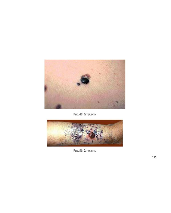 Рак кожи. Меланома: руководство для врачей