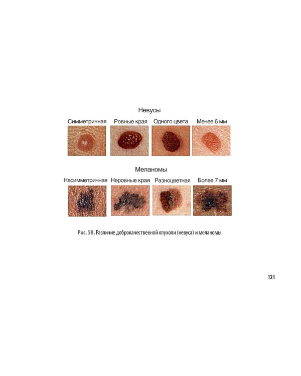Рак кожи. Меланома: руководство для врачей