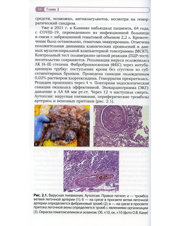 Легочное кровотечение. Руководство для врачей