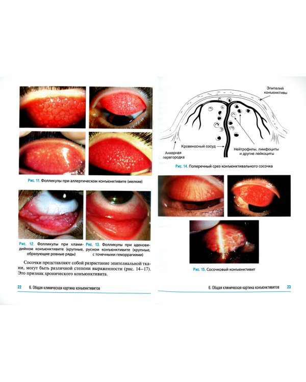 Конъюнктивиты