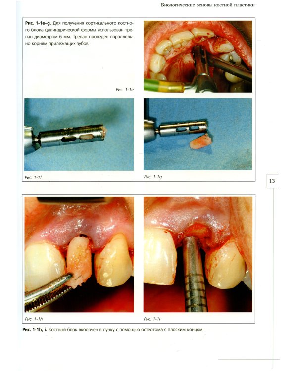 Костная пластика в стоматологической имплантологии. Описание методик и их клиническое применение