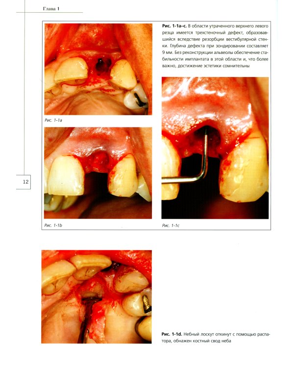 Костная пластика в стоматологической имплантологии. Описание методик и их клиническое применение