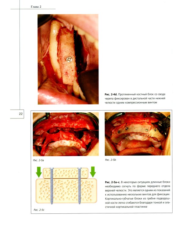 Костная пластика в стоматологической имплантологии. Описание методик и их клиническое применение