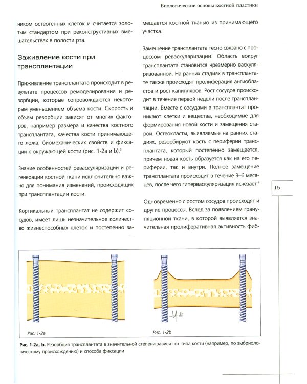 Костная пластика в стоматологической имплантологии. Описание методик и их клиническое применение