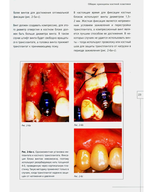 Костная пластика в стоматологической имплантологии. Описание методик и их клиническое применение