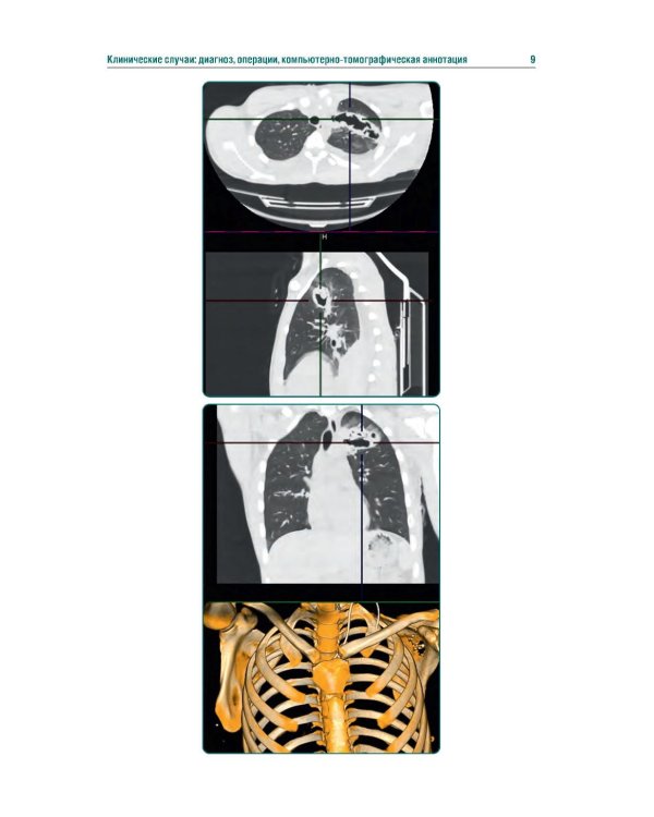 КТ-признаки поражения легких и грудной клетки при боевой травме: атлас