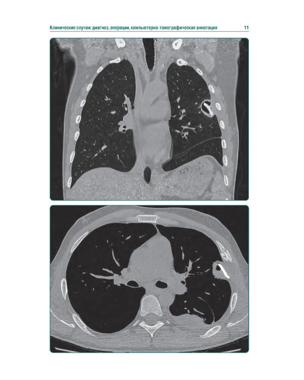 КТ-признаки поражения легких и грудной клетки при боевой травме: атлас