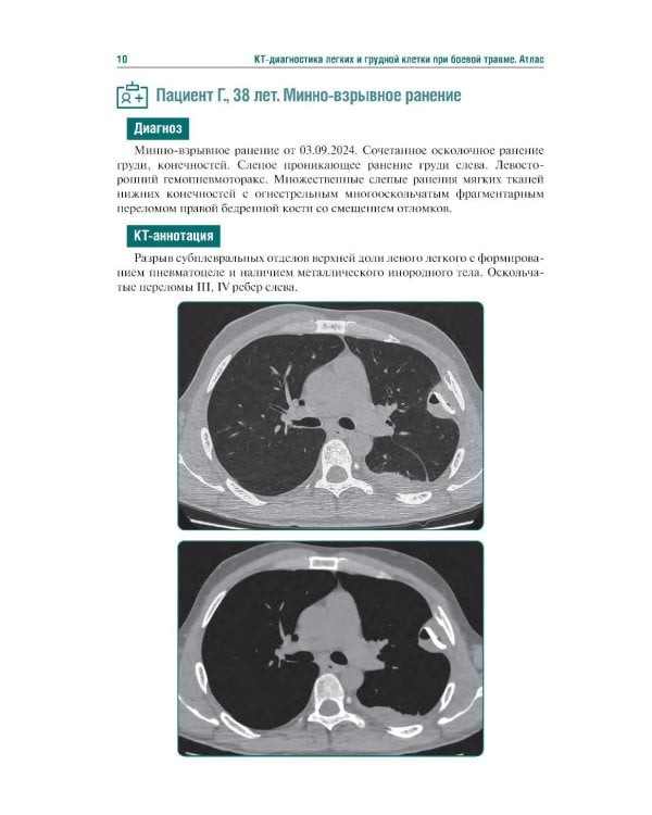 КТ-признаки поражения легких и грудной клетки при боевой травме: атлас