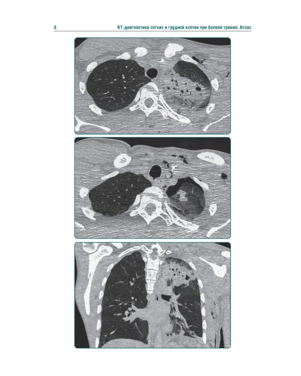 КТ-признаки поражения легких и грудной клетки при боевой травме: атлас