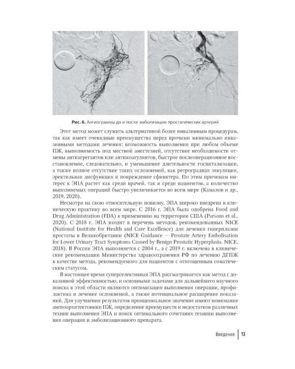 Эмболизация простатических артерий в лечении доброкачественной гиперплазии предстательной железы: руководство для врачей