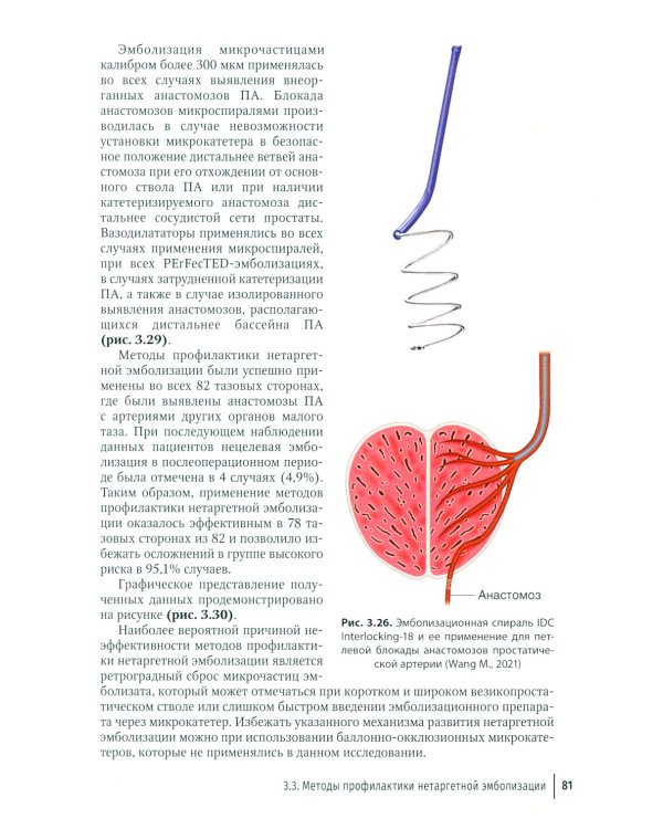 Эмболизация простатических артерий в лечении доброкачественной гиперплазии предстательной железы: руководство для врачей