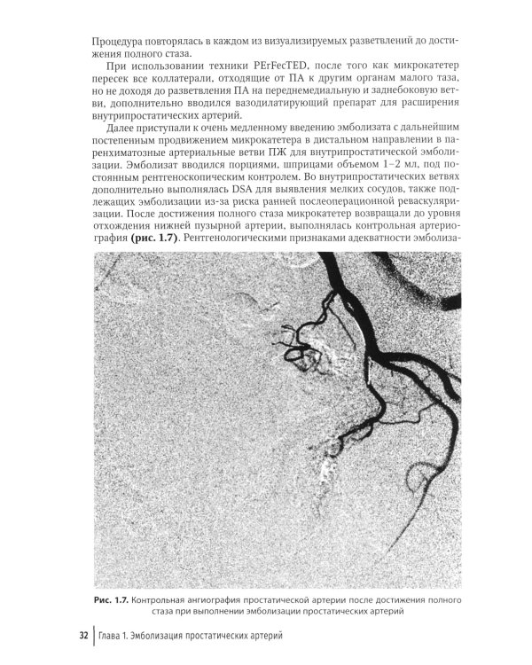 Эмболизация простатических артерий в лечении доброкачественной гиперплазии предстательной железы: руководство для врачей