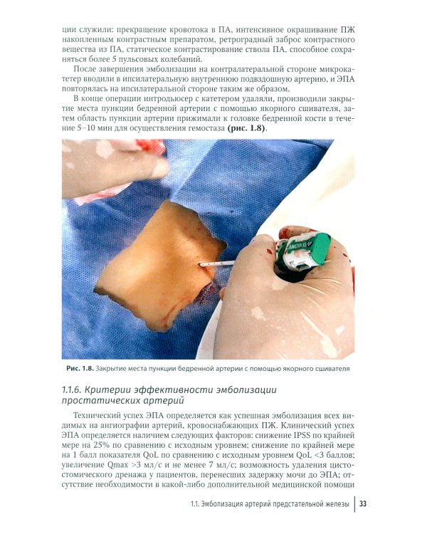 Эмболизация простатических артерий в лечении доброкачественной гиперплазии предстательной железы: руководство для врачей