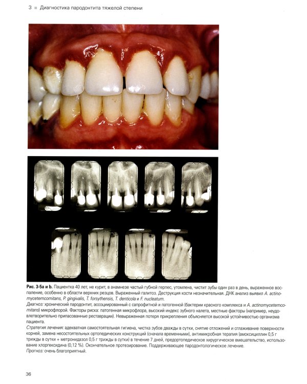 Лечение пародонтита тяжелой степени